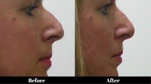 Maybe you would like to learn more about one of these? How Can I Get A Smaller Nose With Non Surgical Rhinoplasty