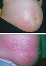 Image result for pruritic urticarial papules and plaques of pregnancy