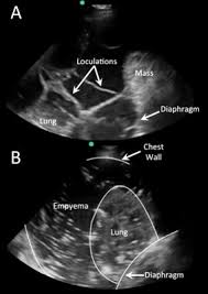 Maybe you would like to learn more about one of these? A Loculated Pleural Effusion A Complex Pleural Effusion Is Shown With Download Scientific Diagram