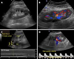 Point Of Care Renal Ultrasonography For The Busy Nephrologist A Pictorial Review