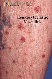 Image result for Vasculitis