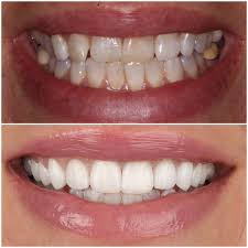 Dental veneers are a cosmetic procedure that can create an even smile due to imperfections such as cracked teeth. Porcelain Dental Veneers In West Hollywood At Smile Atelier