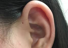 Ia disebabkan oleh bakteria dari cecair yang berkumpul di belakang gegendang telinga dan boleh. Sinus Preauricular Penyebab Gejala Pengobatan Dan Perawatan