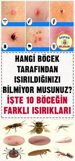 Hayatiniz Boyunca Mutlaka Bir Bocek Tarafindan Isirilmissinizdir Ozellikle De Yaz Aylarinda Bu Kacinilmazdir Isirm Saglikli Yasam Tarzi Saglik Saglikli Yasam