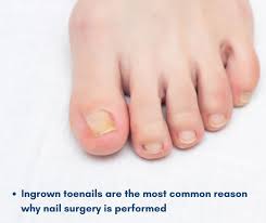 Image result for Toenail Removal