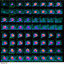 Visit & lookup immediate results now. What To Expect Nuclear Stress Test Myheart Net