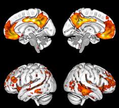 Check spelling or type a new query. The Brain With Dementia Dementia Helpers