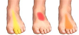 I did have a lot of blisters and the same foot that is experiencing the pain had a bruise under one of my toenails. Grafik Side Foot Pain Diagram Hd Quality Tabletodiagram Bruxelles Enscene Be