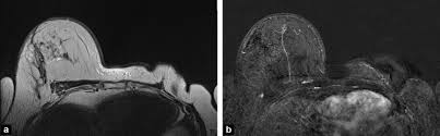Breast magnetic resonance imaging (mri). Imaging Inflammatory Breast Cancer Sciencedirect