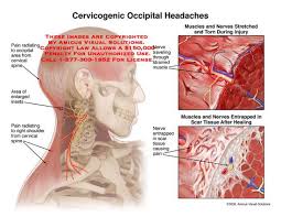 Pin On Thoracic Outlet Syndrome