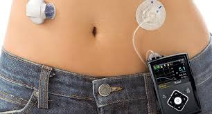 Przewodnik po najlepszych pompach insulinowych dla diabetyków