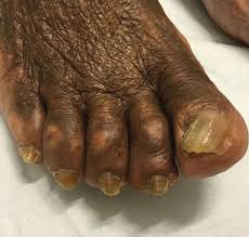 Image result for Onychogryphosis feet
