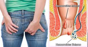¡compre ahora sin necesidad de registrarse! Hemorroides Coloclinic