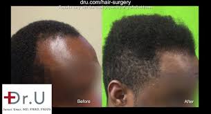 Hair transplants for black women is an option worth exploring. Video Linear Scar Free Black Hair Restoration For All African Hair