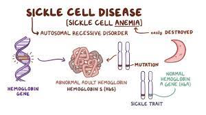 Sickle cell disease is caused by a mutation in a person's hemoglobin, the protein that helps red blood cells carry oxygen through the body. Sickle Cell Disease Clinical Practice Osmosis