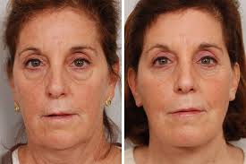 Altus Eyelid Surgery Blepharoplasty Center Eyelid Surgery Surgery Altus