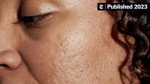 Image result for acne face