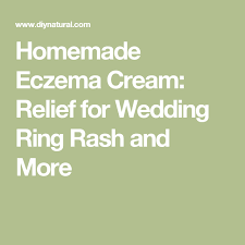 Wedding Ring Rash A Homemade Cream That Relieves And Heals Eczema Cream Essential Oils For Eczema Anti Itch Cream