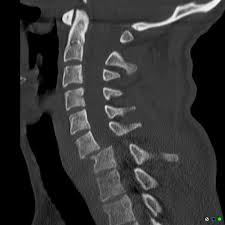 John shows how to open the right facet joints of c2/3 using a rotation thrust and then shows how to close the left c2/3 facet joints by . Bilateral Cervical Locked Facets Radiology Case Radiopaedia Org