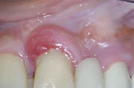 Image result for Periodontal Abscess
