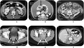Maybe you would like to learn more about one of these? Concerning Ct Features Predict Outcome Of Treatment In Patients With Malignant Peritoneal Mesothelioma European Journal Of Surgical Oncology