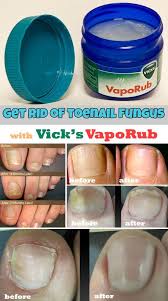 Get Rid Of Toenail Fungus With Vicks Vaporub Welovebeauty Org Nail Fungus Cure Toenail Fungus Cure Nail Fungus Remedy
