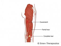 The athlete may feel pain when bending the knee against resistance as the hamstring muscle is put under stress. Hamstring Pulled Torn Information Sinew Therapeutics