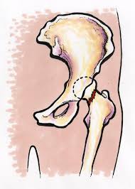 Basert på rct av skruefiksasjon og hemiprotse. Helsearbeiderfag Vg2 Hoftebrudd Og Larhalsbrudd Ndla
