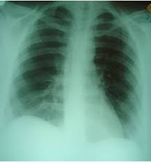 Pulmonary Embolism Presenting With Right Flank Pain Patient Care Online