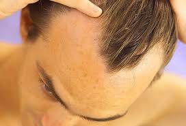 Other causes of hair loss. Hair Loss Treatments Symptoms Causes Prevention