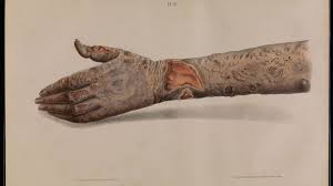 Leprosy Symptoms Pictures Types And Treatment