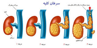 Image result for â«Ø³Ø±Ø·Ø§Ù Ú©ÙÛÙâ¬â