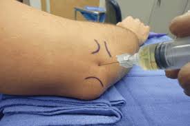 Image result for Elbow Joint Injection