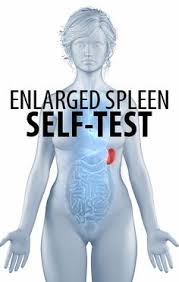 Typically, enlarged spleens are treated by addressing the underlying problem, according to the mayo clinic. 16 Enlarged Spleen Ideas Enlarged Enlarged Liver Heart Symptoms