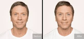 Dermal Fillers Boston MA