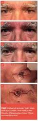 Image result for Eyelid Closure Defect