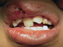 Image result for Tooth Luxation
