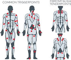 Back Trigger Points Chart Self Massage Trigger Point Guide