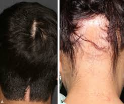 Although it does not cause baldness there is a persistent or cyclical diffuse hair loss and this type of hair loss also occurs with radiation therapy, but it is localized to the area of treatment, for example. Hair Disorders In Cancer Survivors Sciencedirect