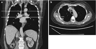 We report 2 cases of pulmonary sarcomatoid carcinoma mimicking malignant mesothelioma. Measuring Malignant Pleural Mesothelioma Springerlink