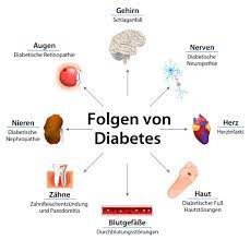 Welche Folgeerkrankungen Kann Diabetes Nach Sich Ziehen