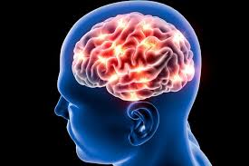 Stroke is the fourth cause of death worldwide. Stroke Signs Symptoms And Treatment Mydr Com Au
