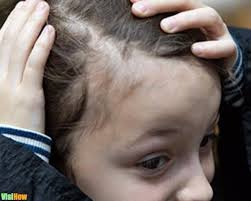 Traumatic alopecia is usually caused by grooming methods that attempt to straighten the natural kinkiness of hair in order to make the hair more manageable. Stop Childhood Hair Loss Due To Tinea Capitis Vs Alopecia Areata Vs Trauma Or Traction Damage And 1 More Visihow