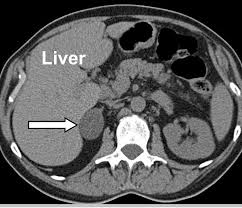 People who have cancer often need ct scans every few months to determine if their treatment is working. Hca Hospital Adrenal Gland Tumor Screening Program