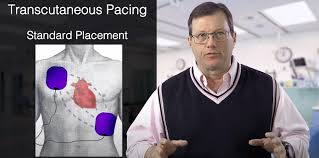 Image result for Transcutaneous Pacing