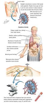 A review and update on recent progress. Hodgkin And Non Hodgkin Lymphoma Blood Cancer Spectrum Health