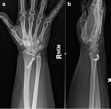 This joint allows a rotary movement of the head of the radius. Subtle Radiographic Findings Of Acute Isolated Distal Radioulnar Joint Dislocation Springerlink