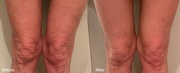 You may notice improvement immediately following treatment, but final results take up to 3 months following each treatment. What Is Morpheus8