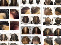 Best hair loss treatment for crown of head: Hair Loss In Young Indian Women Attributed To Stress