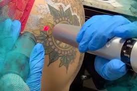 Does laser tattoo removal cause cancer. Tattoo Removal Methods Removery